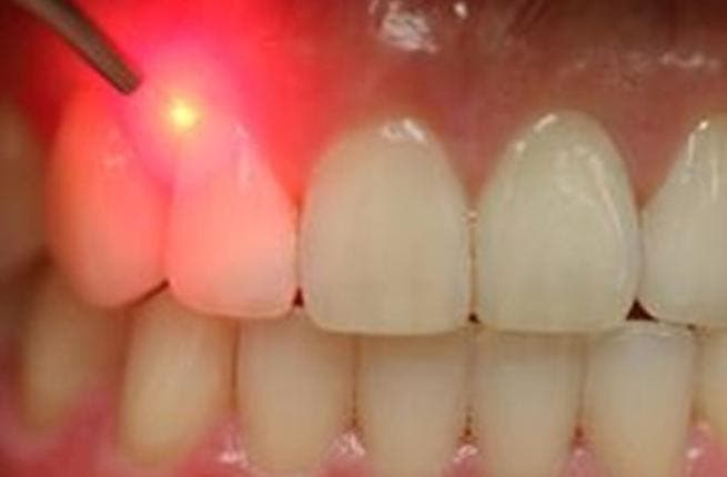 كيفية علاج الاسنان بالليزر ومميزاته وعيوبه