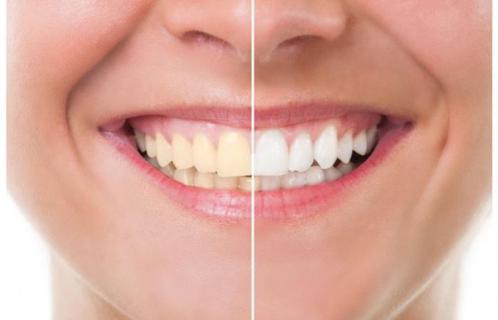 افضل طرق تبيض الاسنان من مستحضرات الطبيعية لإزالة الجير والاصفرار نهائيا