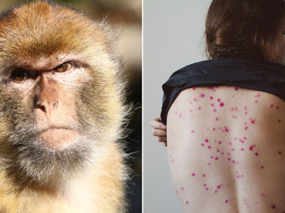 ما هو مرض جدري القرود وما هي أعراضه